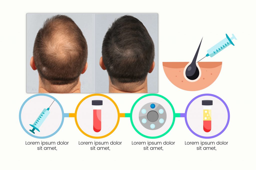 I Got PRP Injections For Hair Loss: See Photos | POPSUGAR Beauty UK